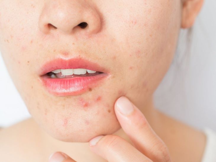 19+ Thuốc Trị Mụn Trứng Cá Tốt Nhất Hiện Nay Nhiều Chị Em Tin Dùng